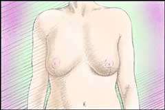 breastreduction_d.jpg